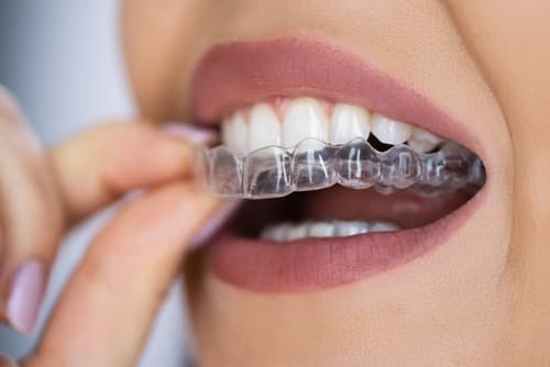 Invisalign®