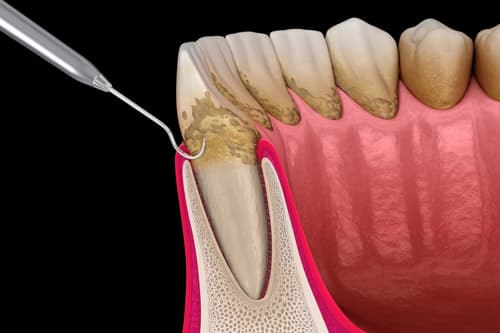 Limpeza, alisamento e polimento das raízes